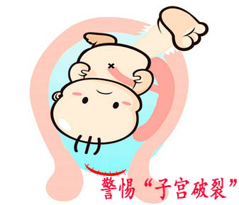 子宫破裂.jpg