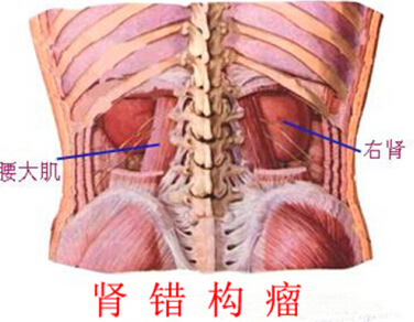 肾错构瘤.jpg