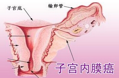 子宫内膜癌.jpg