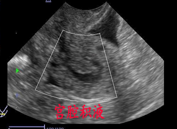 宫腔积液.jpg