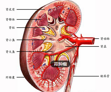 肾肿瘤