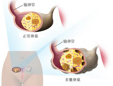 多囊卵巢综合征