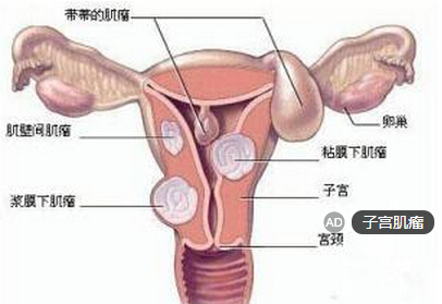 子宫肌瘤