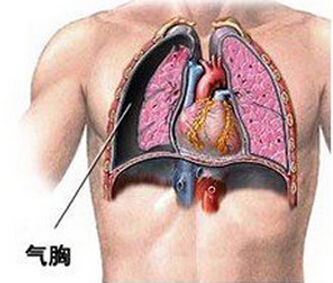自发性气胸