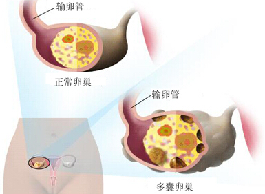 多囊卵巢综合征