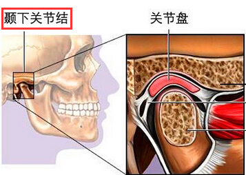 颞下颌关节脱位