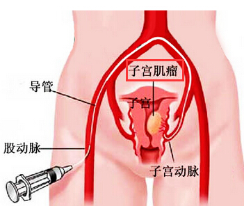 子宫肌瘤