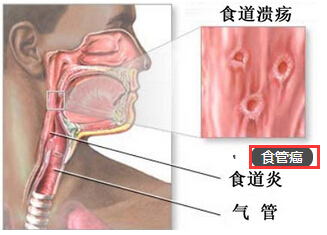 食管癌