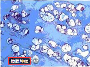 腹膜肿瘤