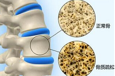 骨质疏松