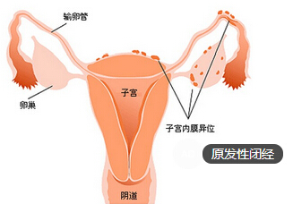 原发性闭经