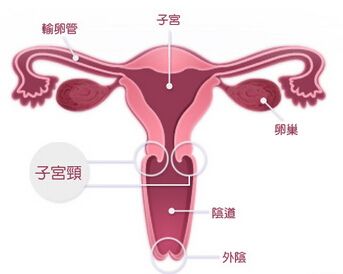 宫颈癌