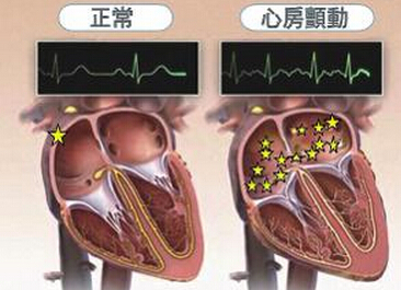 心房颤动