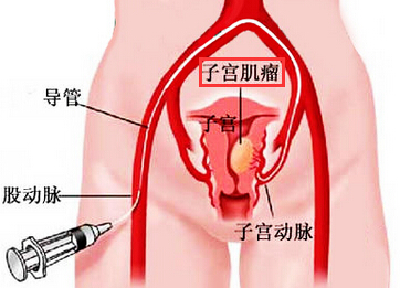 子宫肌瘤