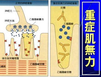 重症肌无力