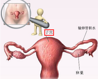 功能失调性子宫出血