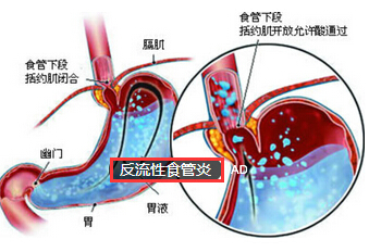 反流性食管炎