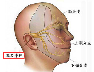 三叉神经痛