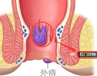 肛门异物