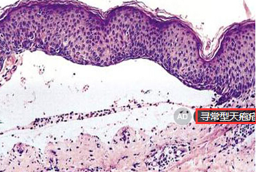 寻常型天疱疮
