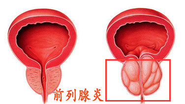 前列腺炎