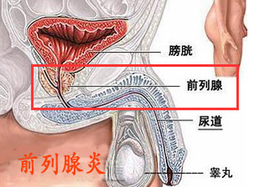 前列腺炎02.jpg