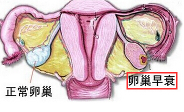 卵巢早衰