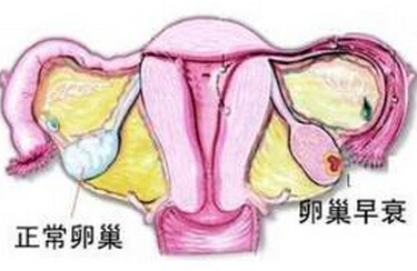 卵巢老化