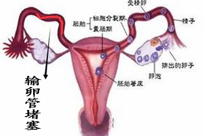 输卵管堵塞