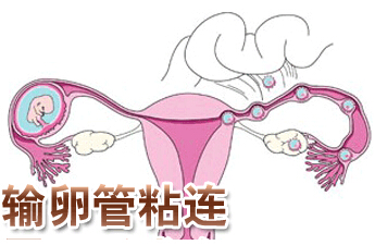 输卵管粘连