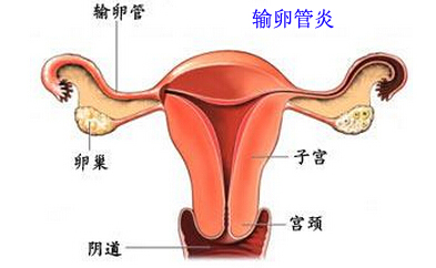 输卵管炎