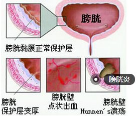 膀胱炎