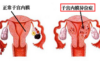 子宫内膜异位症