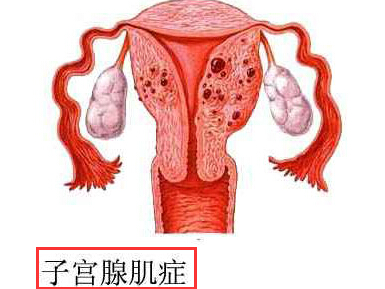 子宫腺肌症
