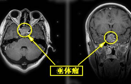 垂体瘤