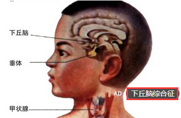 下丘脑综合征