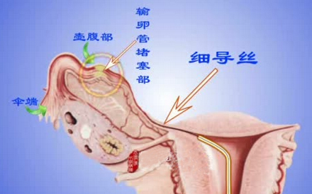 输卵管堵塞