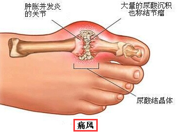 痛风石