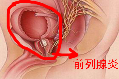 衣原体前列腺炎