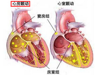 心房颤动