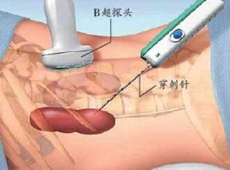 肾病综合征