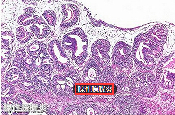 腺性膀胱炎