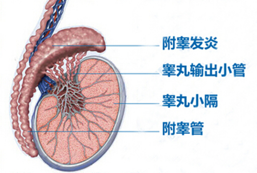 附睾炎