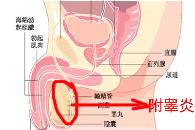 慢性附睾炎