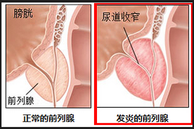 前列腺炎