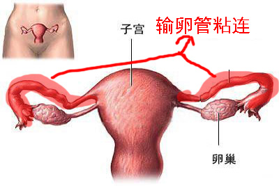 输卵管粘连