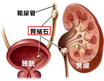 肾结石