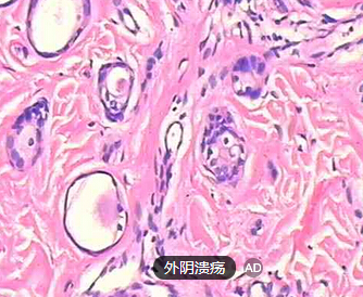 外阴溃疡