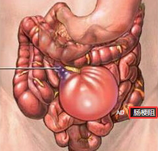 肠梗阻