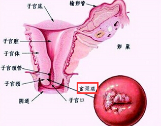 宫颈癌